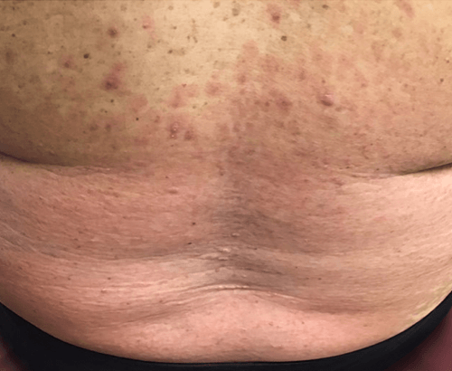 Patient results after 2 doses of SKYRIZI® at Week 16.
