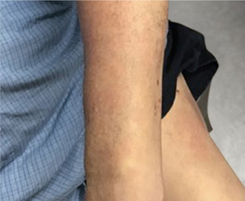 Patient results after 2 doses of SKYRIZI® at Week 16.