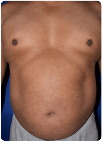 Before and After: 2 doses Week 16 PASI improvement of chest.