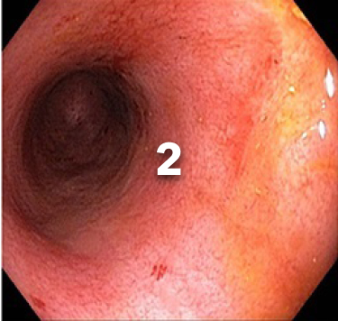 endoscopy of a colon with subscore 2