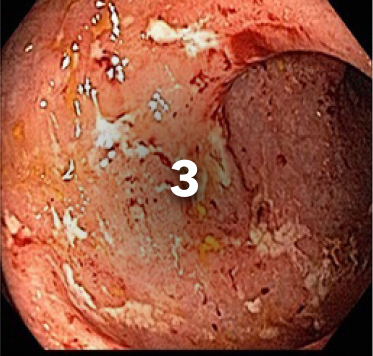 endoscopy of a colon with subscore 3